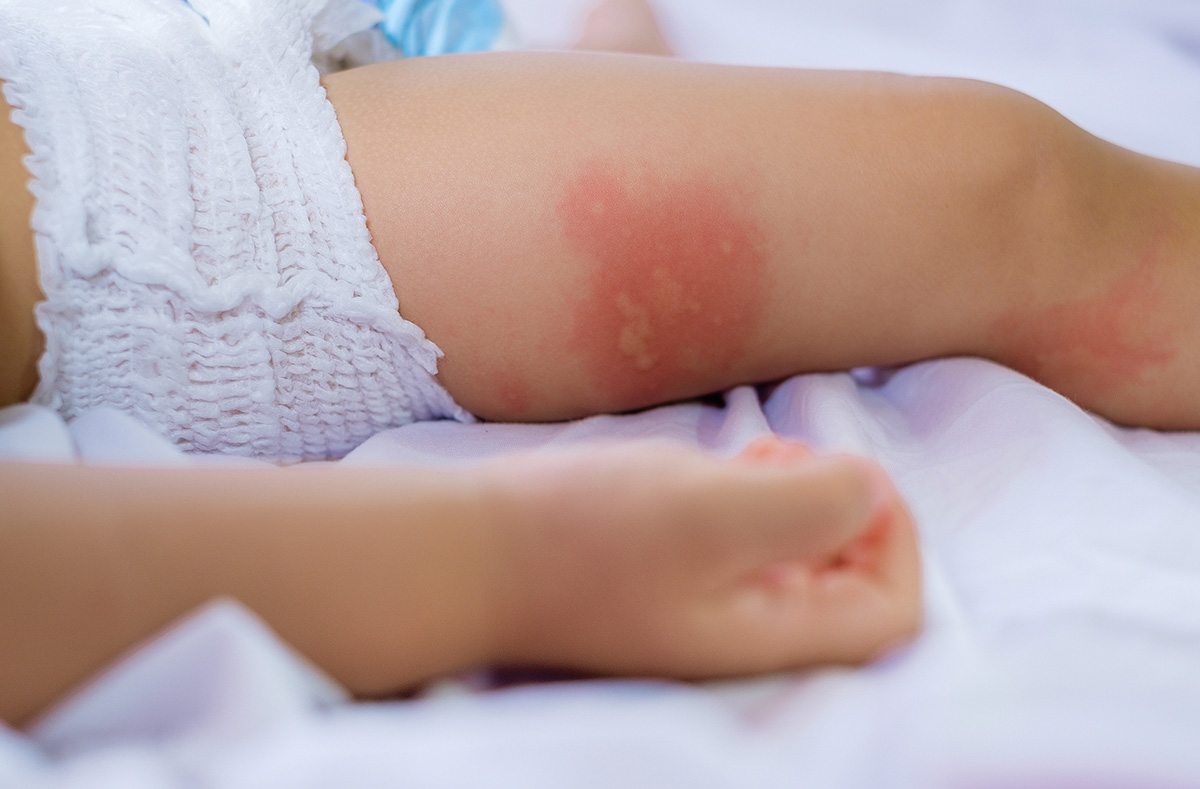 Childhood Rashes